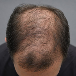 Calvice Masculina
